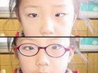 幼儿斜视