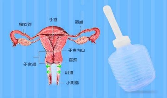 一次性使用阴道冲洗器