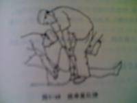 髋关节滑囊炎