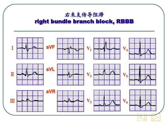 右束支传导阻滞
