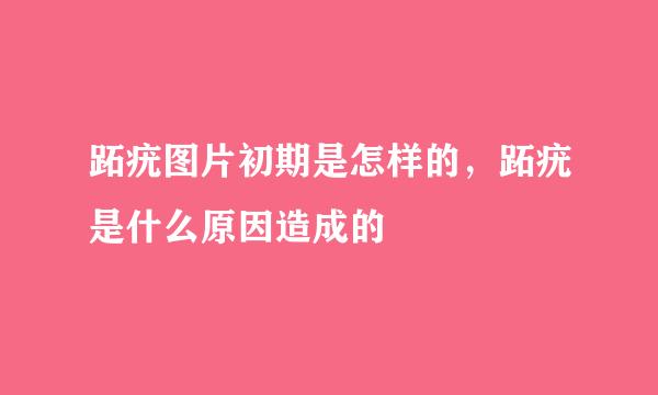 跖疣图片初期是怎样的，跖疣是什么原因造成的