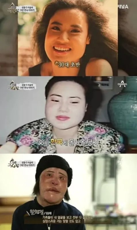 曾是高配版林允儿,整容上瘾后自己注射色拉油,结果怎么样了呢?