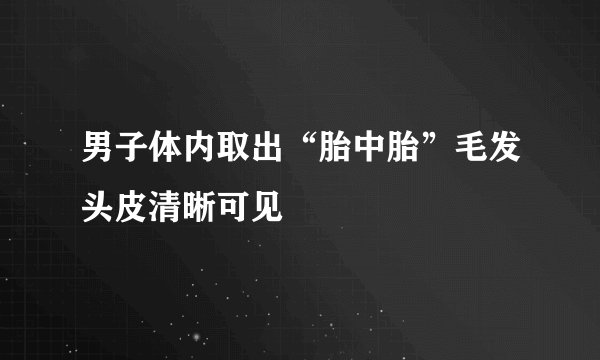 男子体内取出“胎中胎”毛发头皮清晰可见