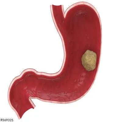 胃穿孔怎么做手术