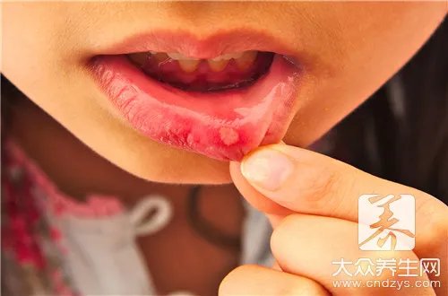  灼口症是怎么引起的