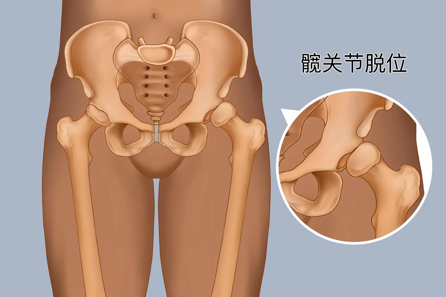 左右胯骨不对称图片