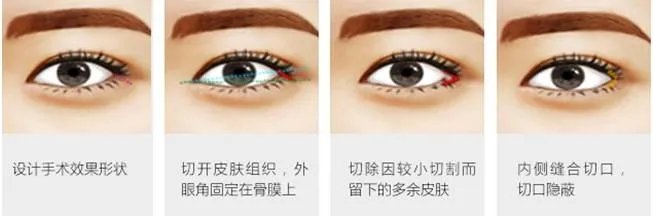 开外眼角手术优势和适合人群都有哪些？