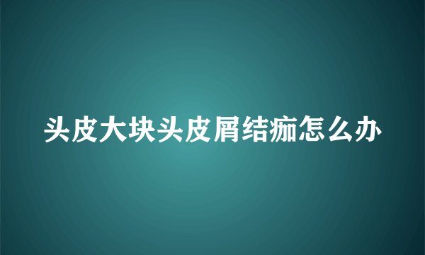 头皮大块头皮屑结痂怎么办
