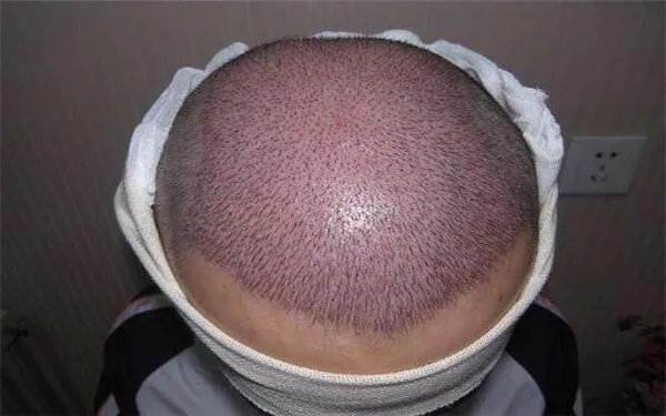 植发贵吗