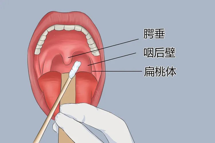 咽拭子采样三个部位的具体图片