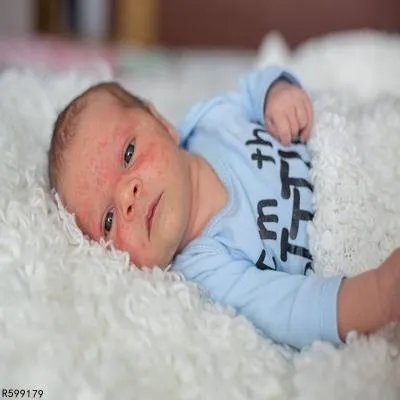 新生儿怎么预防湿疹 预防新生儿湿疹3招数分享