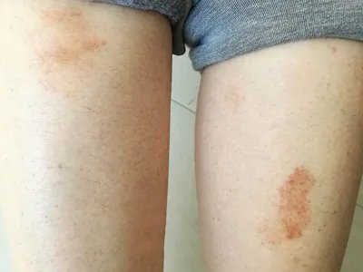 进行性色素性紫癜性皮肤病症状图片