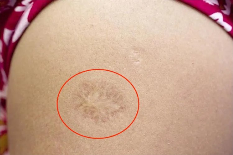 卡介苗和牛痘疤痕区别图片