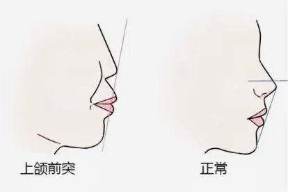 上颌骨突出的脸型图