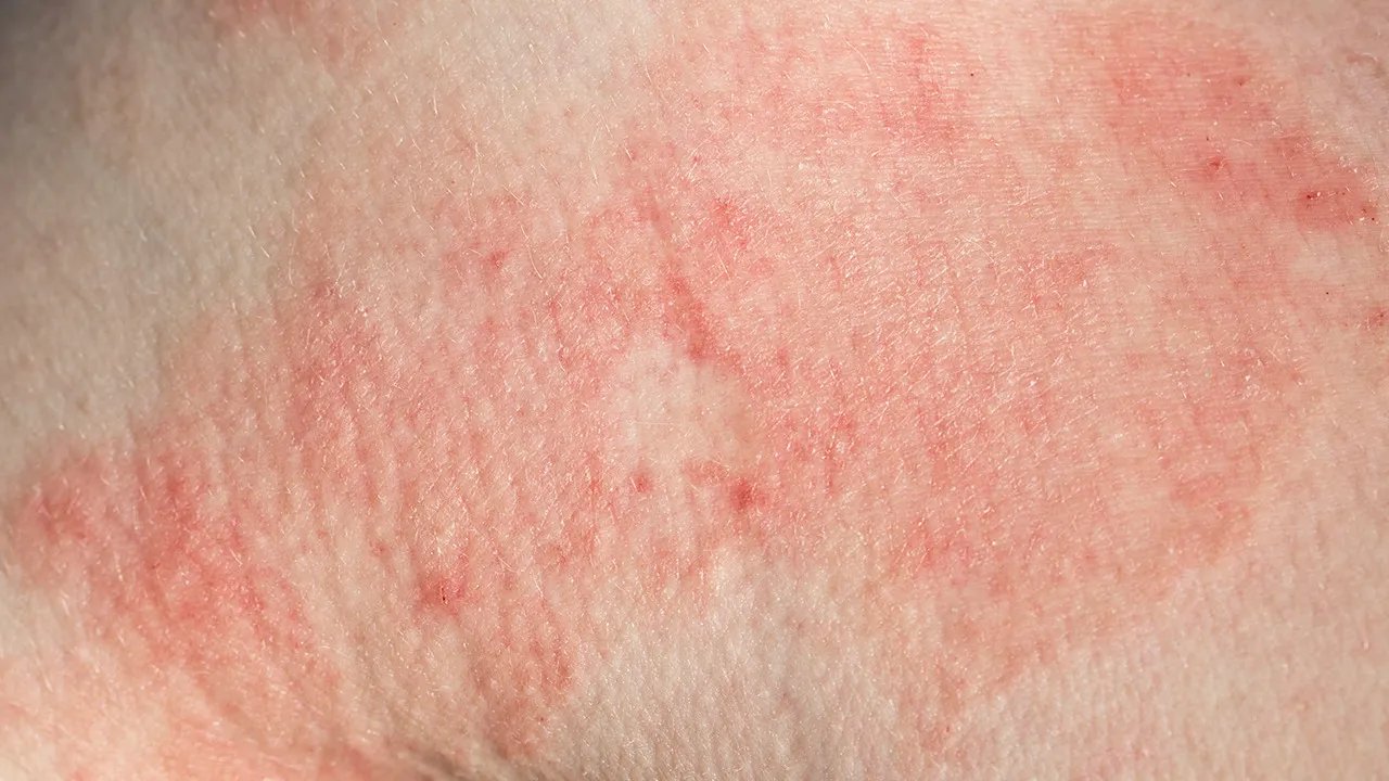 湿疹有哪些症状表现