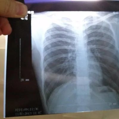 胸膜炎怎么治