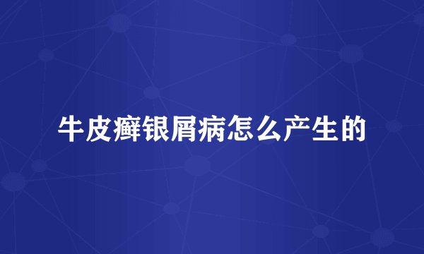 牛皮癣银屑病怎么产生的