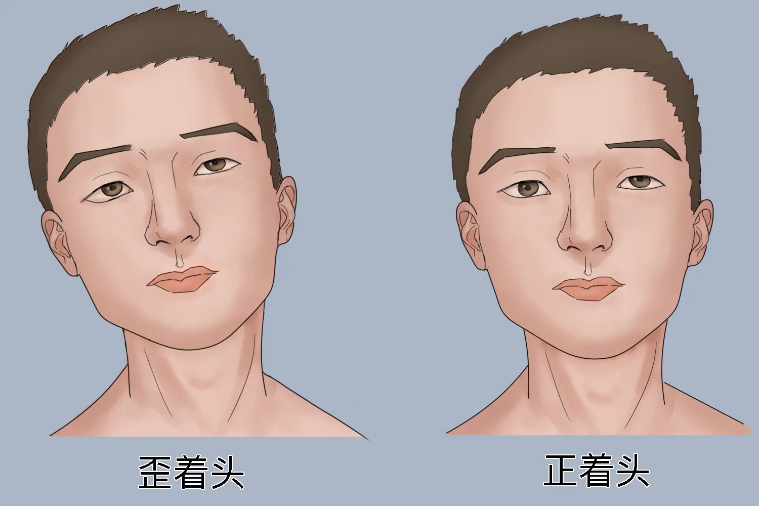 麻痹性斜视图片