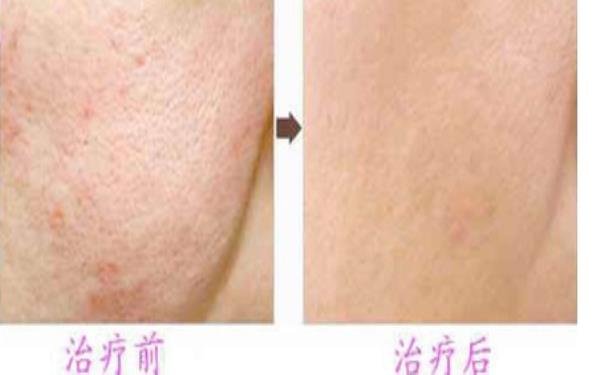 美白嫩肤要多少钱