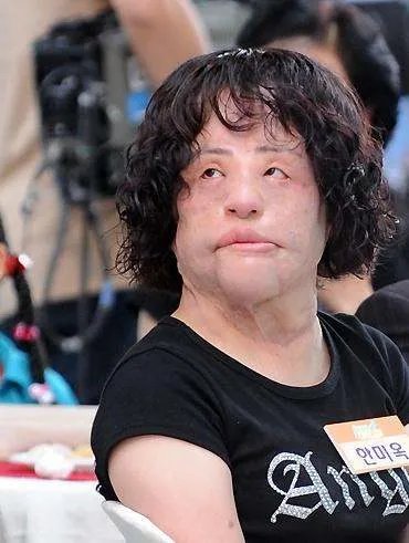 曾是高配版林允儿,整容上瘾后自己注射色拉油,结果怎么样了呢?