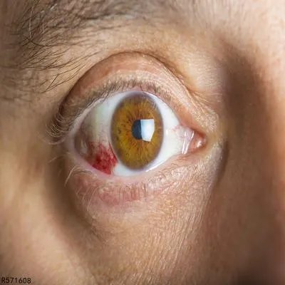 红眼病有哪些危害 解析红眼病的四大危害