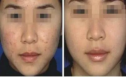 怎样用茄子祛斑