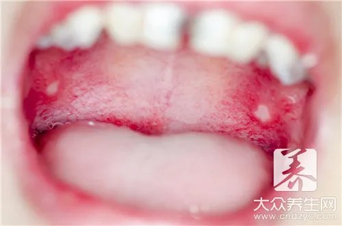 灼口症是怎么引起的