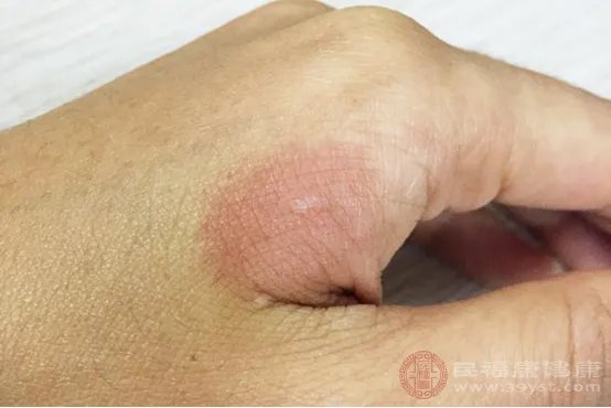 烫伤怎么处理