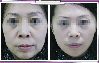 胶原蛋白除皱要多少钱？
