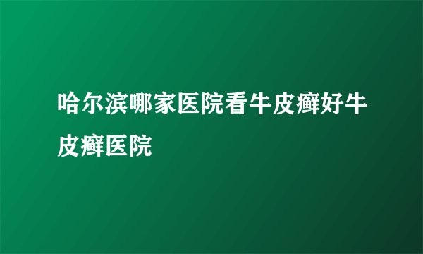 哈尔滨哪家医院看牛皮癣好牛皮癣医院