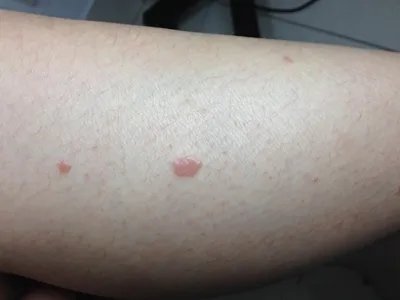 扁平疣样职业性疣赘小腿症状图片