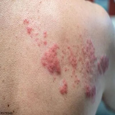 病毒性疱疹多久能治好 多个方法可根除病毒性疱疹